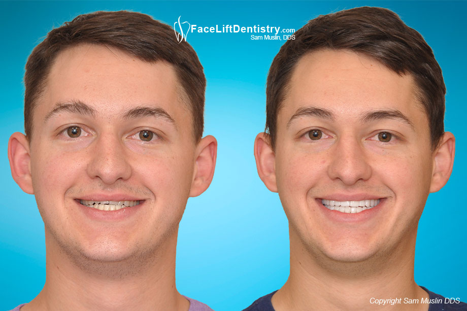 Before and After adult underbite optimization without surgery or braces.