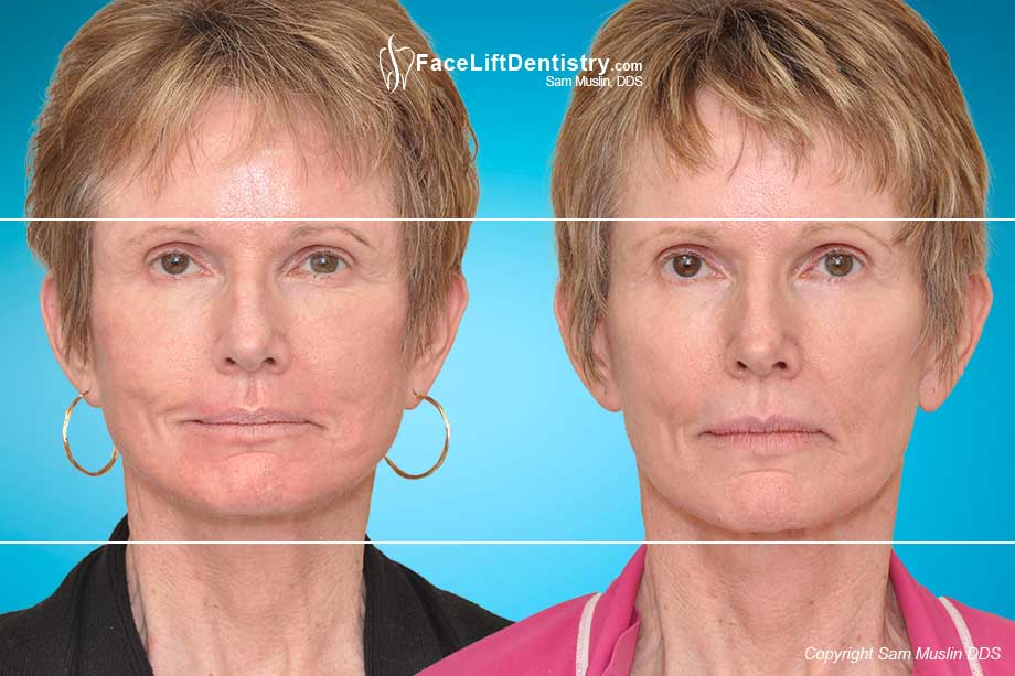 Reversing Aging and Facial Collapse by optimizing the jaw position