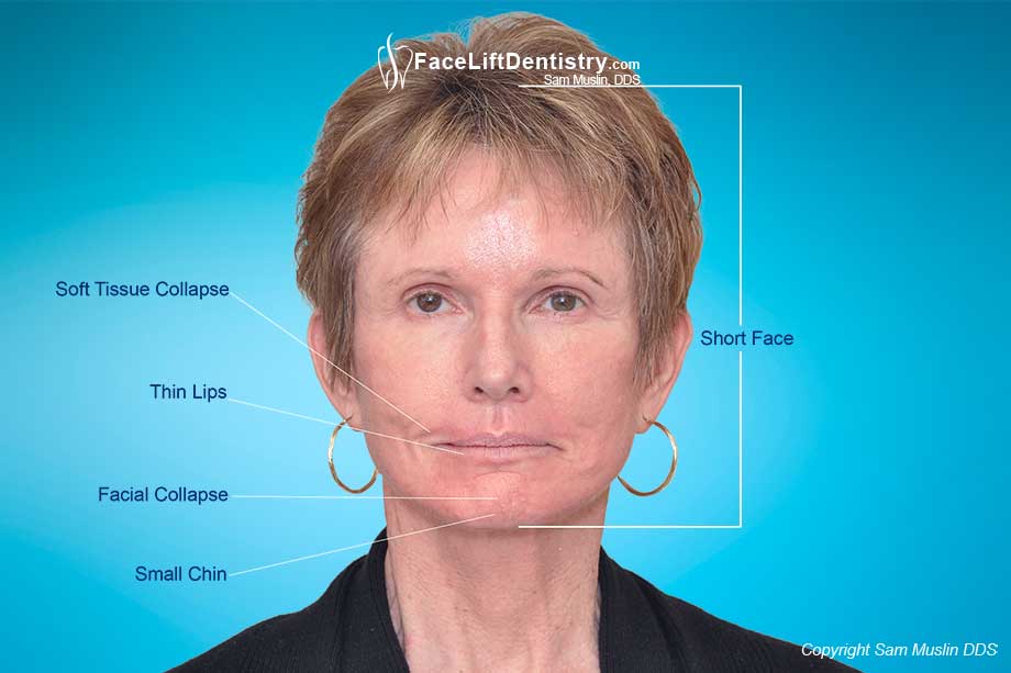 Photo highlighting the symptoms of facial collapse