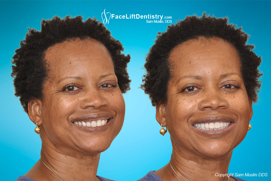 A patient with an overbite and receding chin in the before photo, compared with a true Dental Facelift in the after photo.