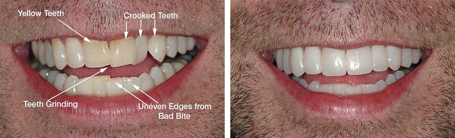 The before and after closeup of a 2-week smile makeover with prepless non invasive veneers.