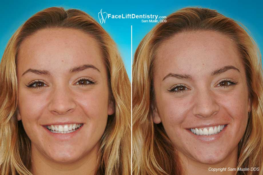  Before and after photo of a young lady who had her smile enhanced with prepless teeth veneers for an even bright white smile.
