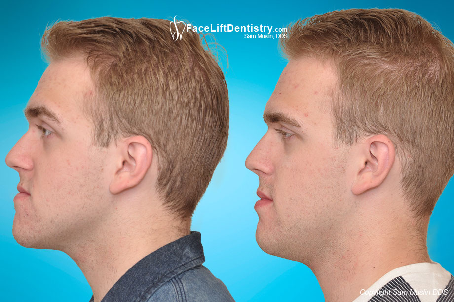 Before and After profile photo of adult male after protruding chin and underbite corrected