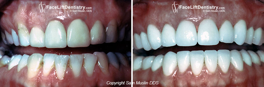  Gummy Smile fixed with Advanced Cosmetic Dentistry