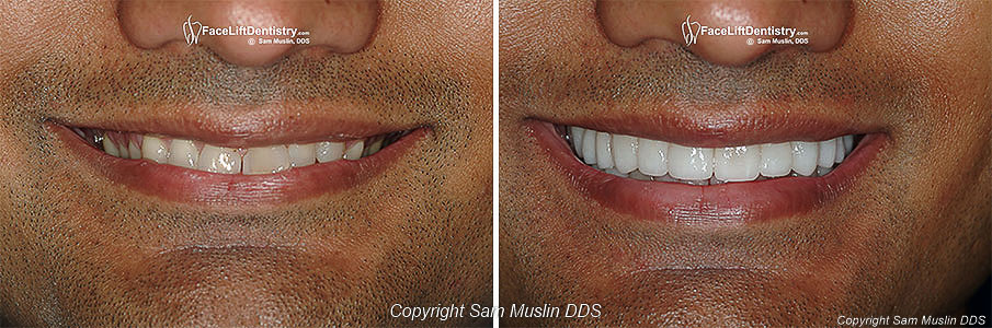 alternative-overbite-correction-closeup.jpg