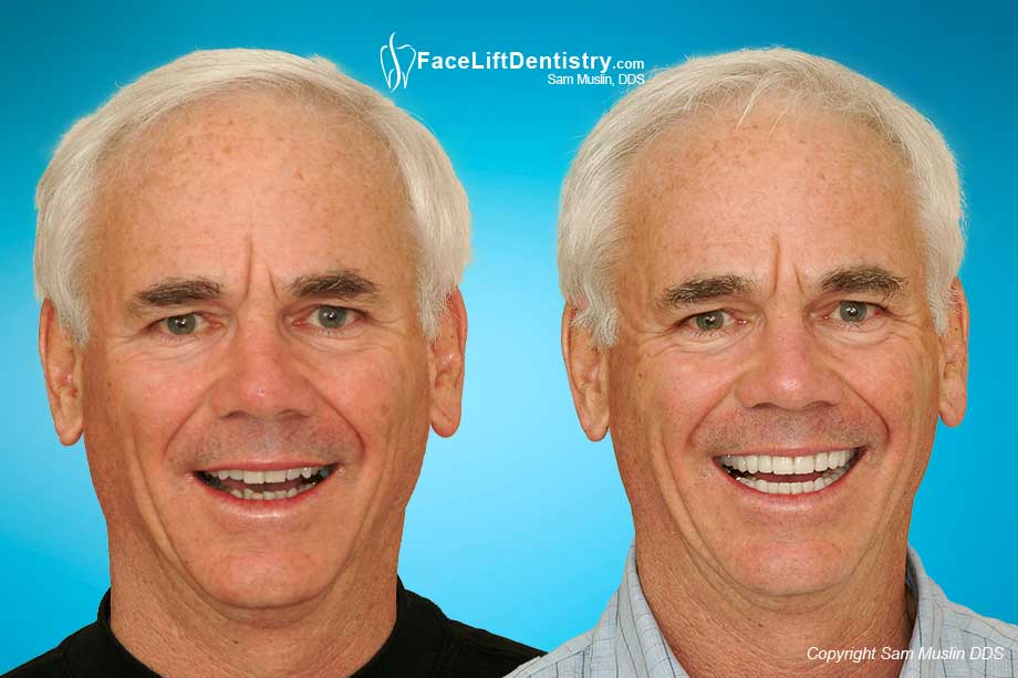  Anti-Aging Cosmetic Dentistry - Before and After