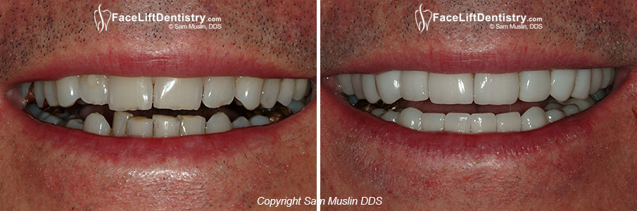 Anti-Aging Cosmetic Dentistry - Closeup - Before and After
