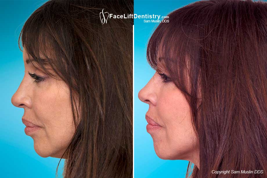  Anti-Aging dentistry corrected her profile and gave her a younger look - Before and After treatment