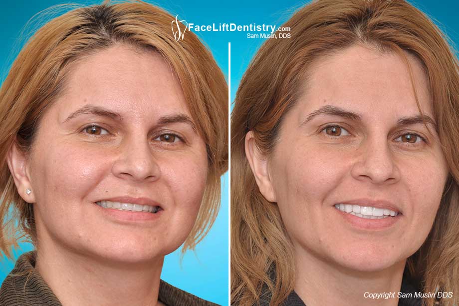 Anti-Aging Profile Correction with VENLAY<sup>®</sup> Restorations