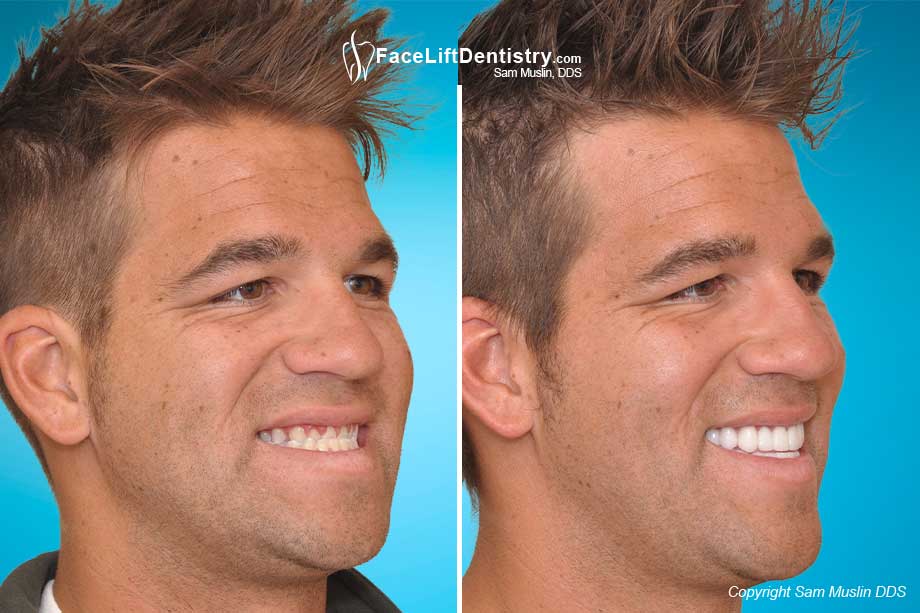 Large-Looking Chin and Malocclusion  Corrected - Before and After Treatment
