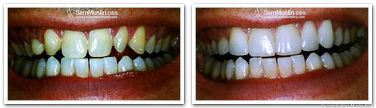 A Baby Boomer shows the difference Porcelain Veneers make in these closeup photos