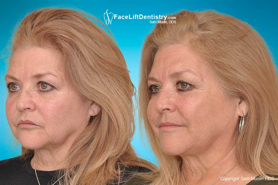 The wrong jaw position and bite can minimize our facial aesthetic potential. The After-Photo on the right shows a much improved jaw position and bite.