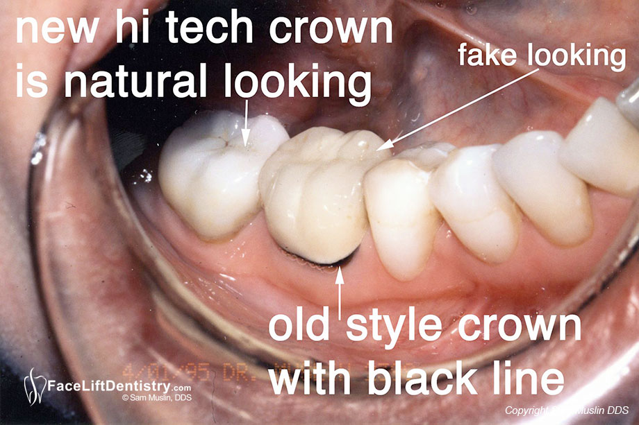  Old Style Crown with Black Gum Line