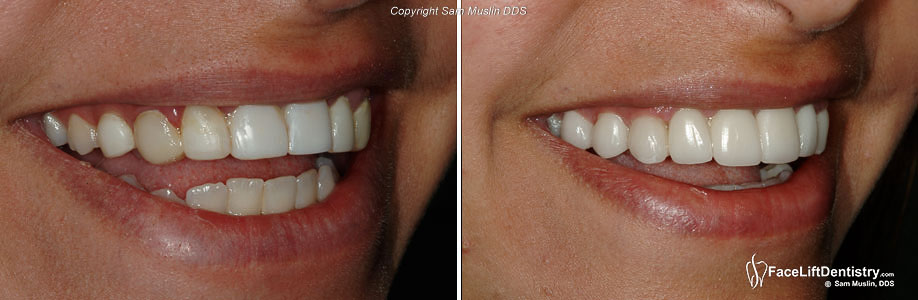  Bad Porcelain Veneers Replaced - Before and After
