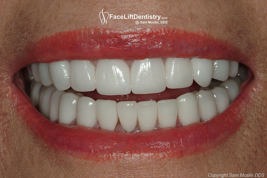 The photo shows the same patient with her bite corrected and porcelain veneers replaced.