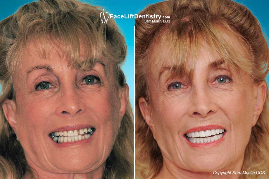  Before the treatment the stress on the mouth is quite visible, which probably resulted in broken veneers. After the treatment the patient now has her ideal jaw position and jaw TMJ stress is greatly reduced.