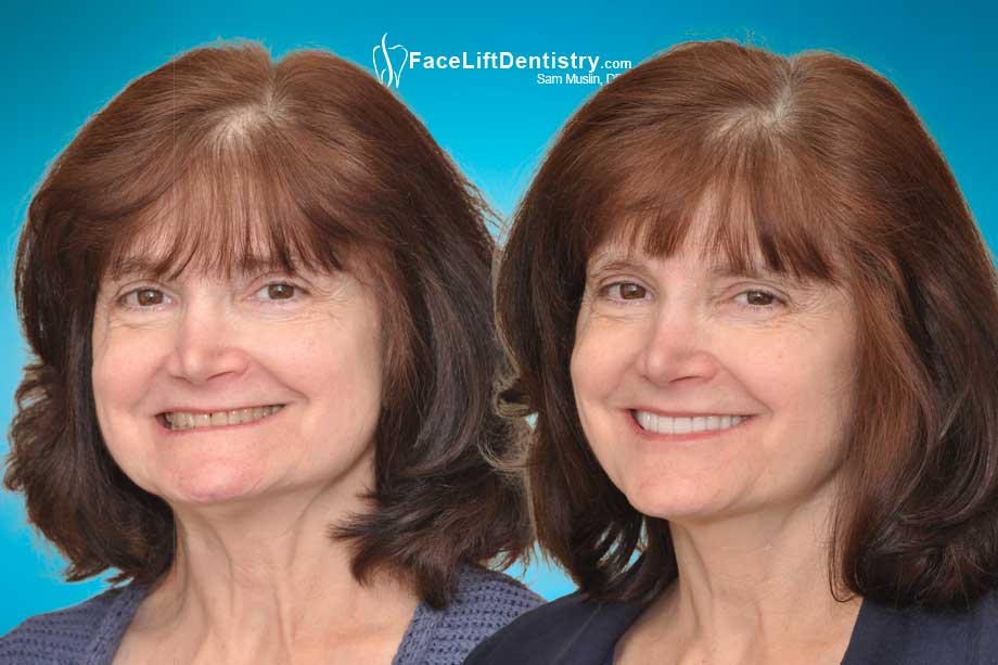 Before and after photo showing corrected facial collapse and deep overbite.