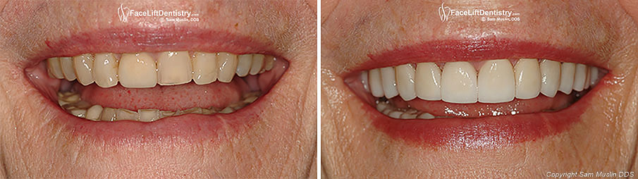 Close-up Photo showing Before and After Bite Correction
