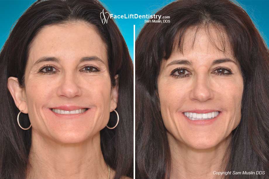 A Dental Facelift and Profile Correction - Before and After