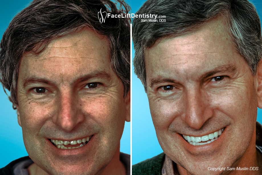 Patient showing Full Mouth Reconstruction - Before and After