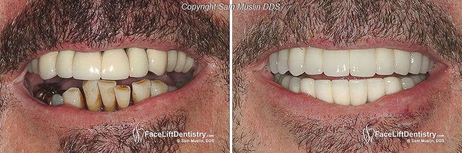  Teeth Extractions followed by Bone Grafts and Temporary Bridges