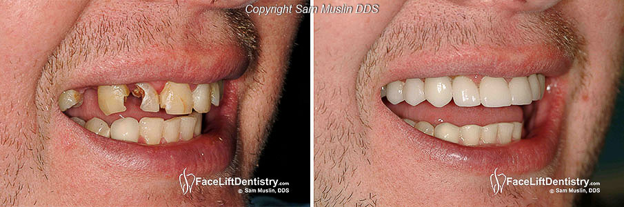  Close-up of broken teeth before and after treatment