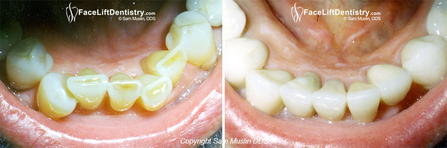 New Crowns - Healthy Gums and Straight Teeth