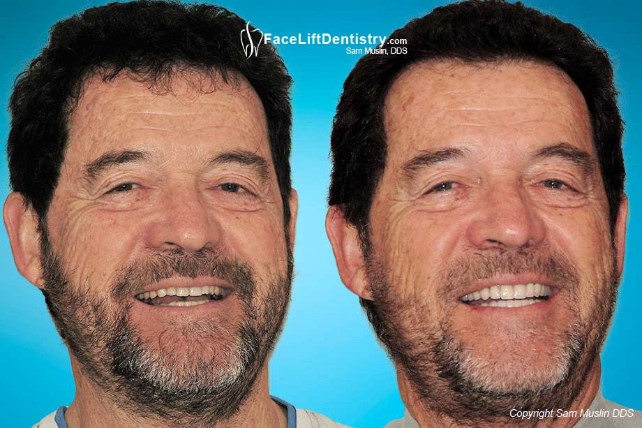 Cosmetic Anti-Aging Facelift Dentistry - Before and After Photos