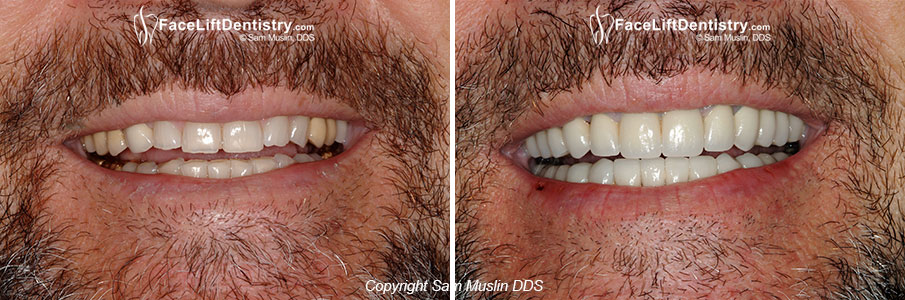 Before Anti-Aging Dentistry Photos - Before and After