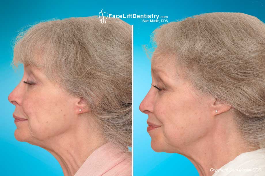 The Cosmetic Benefits of VENLAY, Before and After Photo