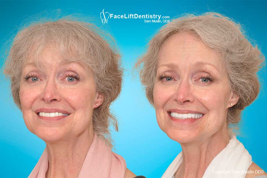 Old Cosmetic Dentistry Replaced with VENLAY Restorations - Before and After Photo