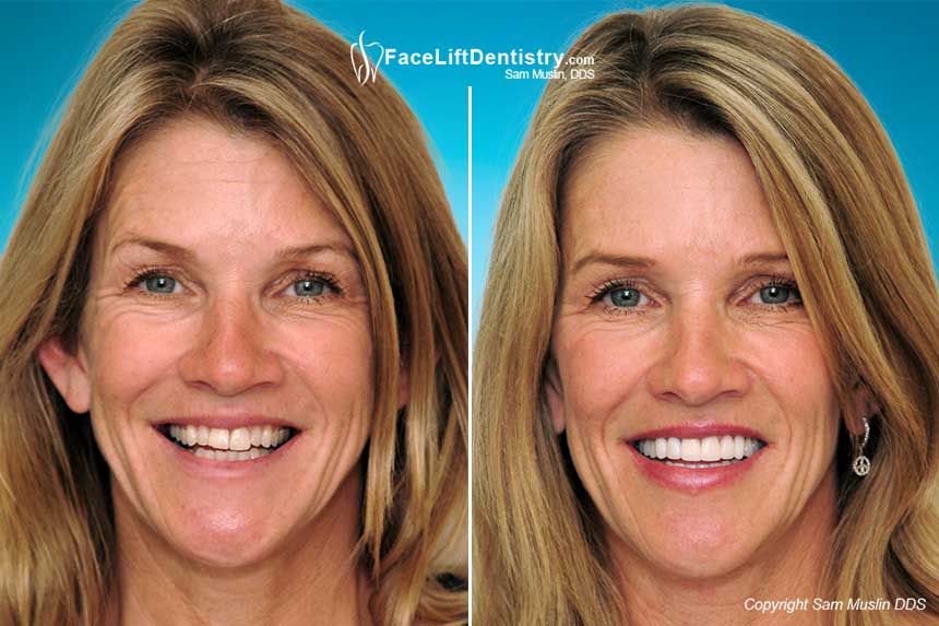 With veneers it is about the smile - with Face Lift Dentistry it is about the entire face - Before and after treatment.