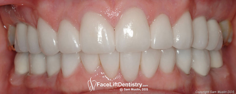 overbite deep does correction showing close corrected affect faceliftdentistry