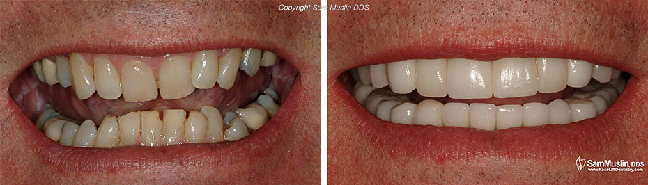 Closeup photo of a deep bite, before and after treatment.