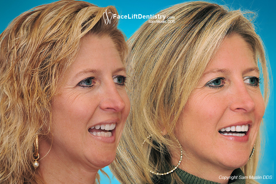 Teeth angled inward made her overbite worse. The after photo was taken after treatment without braces or aligners.