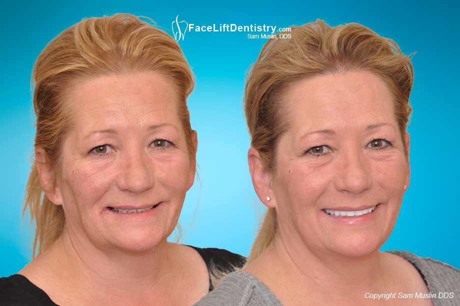  Before and After neuromuscular dentistry problems corrected with the Face Lift Dentistry<sup>®</sup> method.