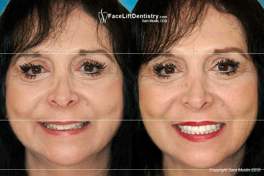  Before and After picture showing the revitalizing effect of the Dental Face Lift