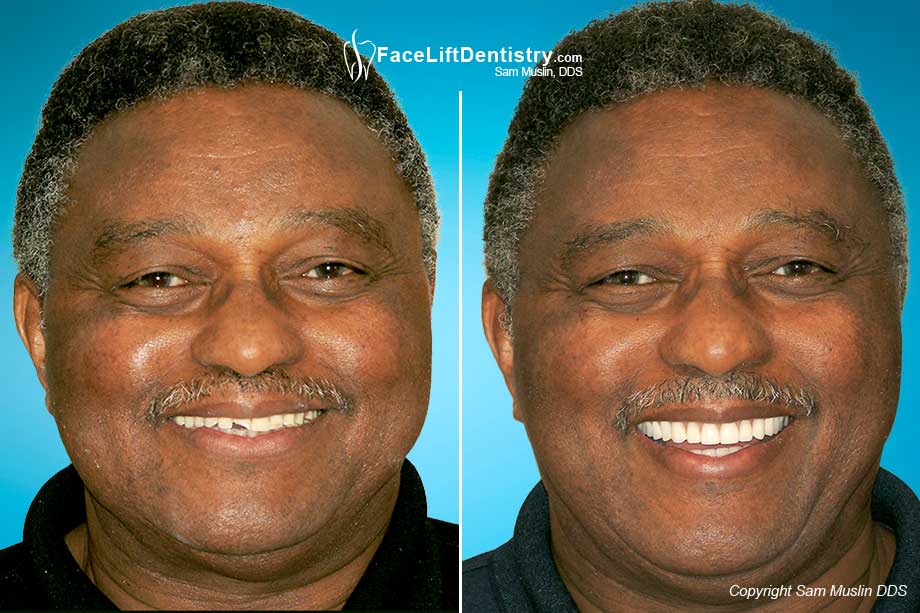  Before and After Facelift Dentures®