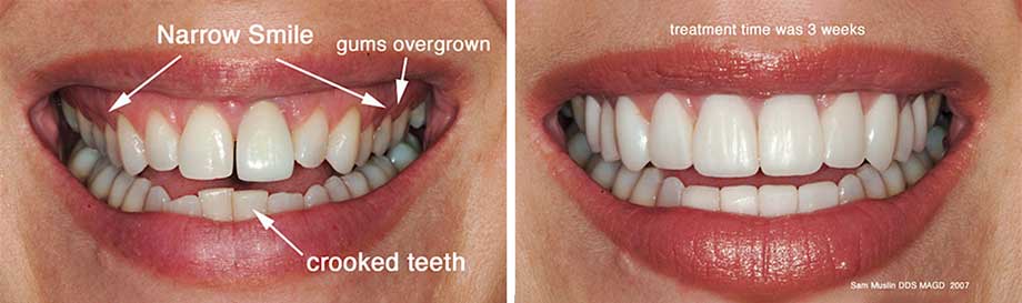 A closeup showing the outcome of dental veneer treatment to widen a smaile and address crooked teeth and overgrown gums.