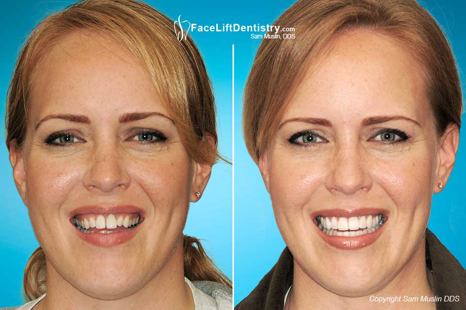 The before after photos show improved lip and cheek support as a result of dental veneers resulting in a wider smile.