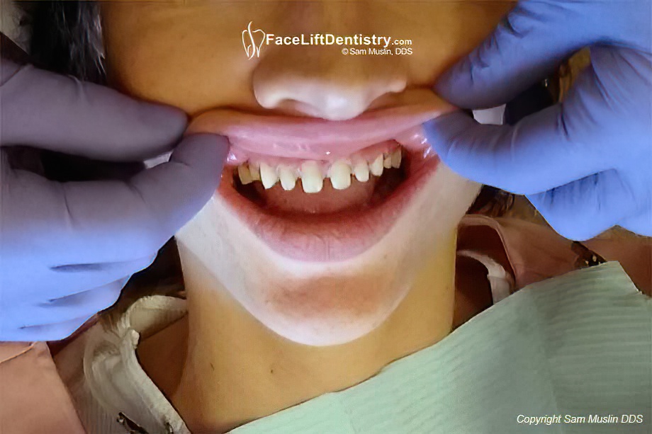 Healthy Tooth Enamle Drill Down for Porcelain Veneers 