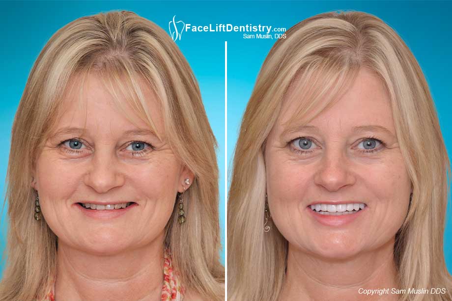 Face Lift Dentistry - Before and After 