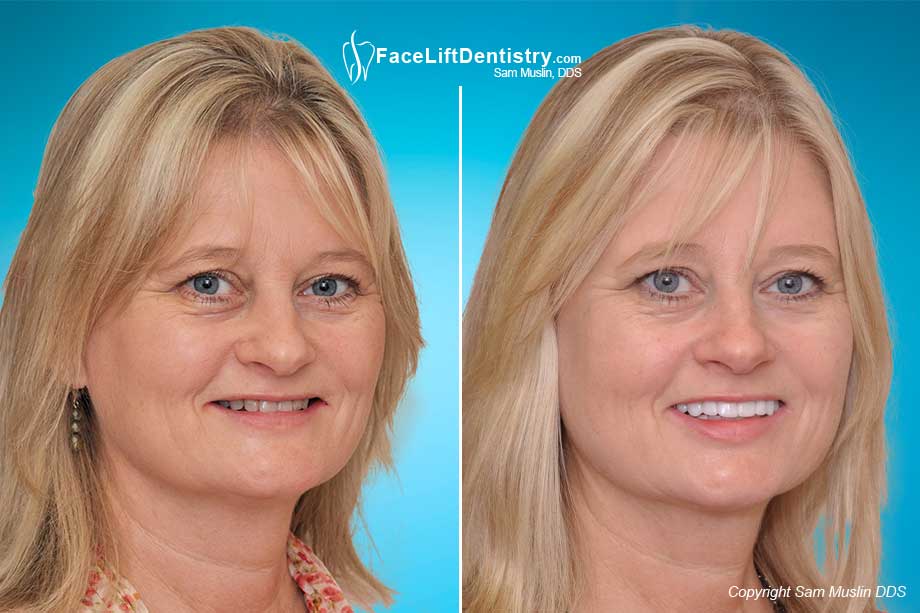 Face Lift Dentistry and Mouth Collapse 