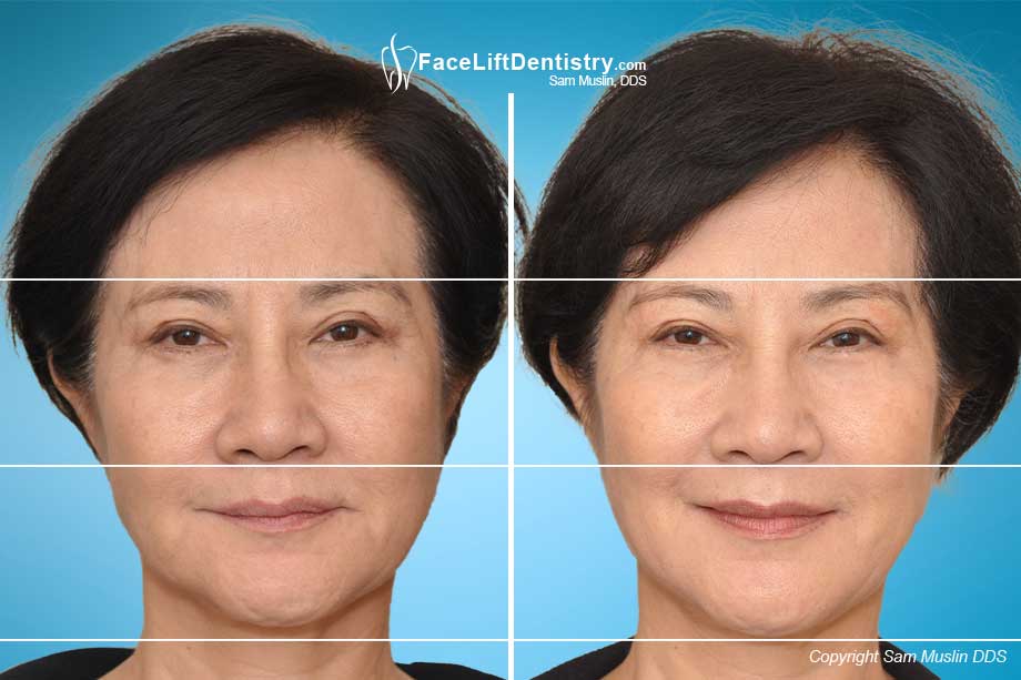 The effects of facial collapse is evident in this before and after photo.