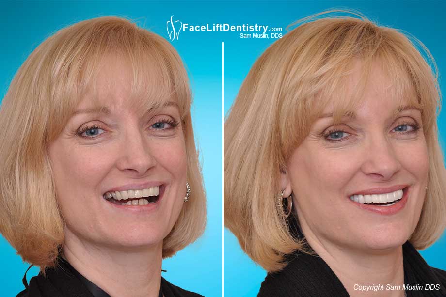 An overbite distorts facial balance. The after photo shows how effective overbite correction can be to reclaim the beauty within.