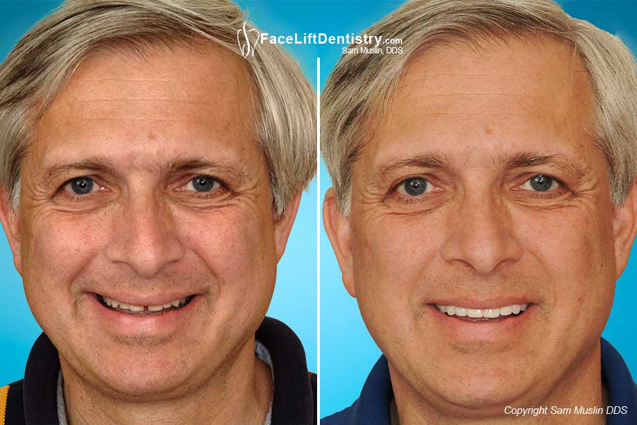 Bruxism effects on the face reversed - before and after photo