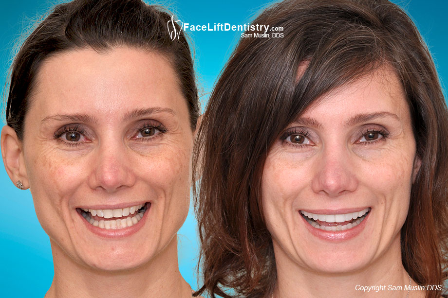 Before and After photo showing the results of facial tension reversal.