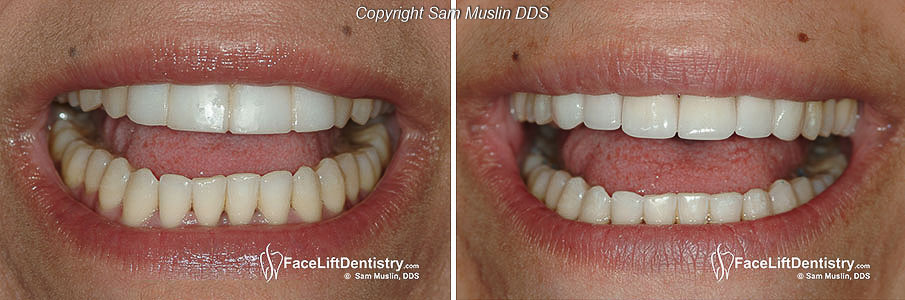 Fake-looking porcelain veneers was removed and replaced with ultra-thin custome veneers.