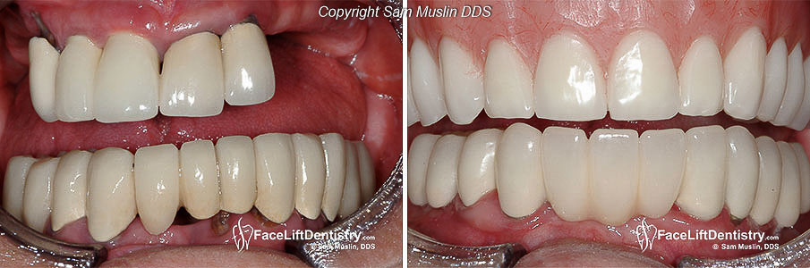  Photo showing Fixed Bridges and Dentures - Before and After