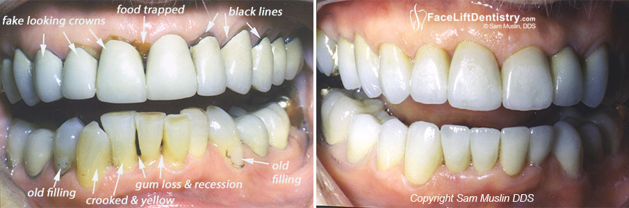 Fixing Black Lines from Crowns - Before and After Picture